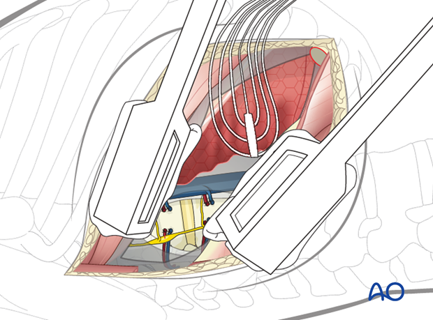 Thoracic and lumbar fractures: Right sided thoracotomy (T3-T10)