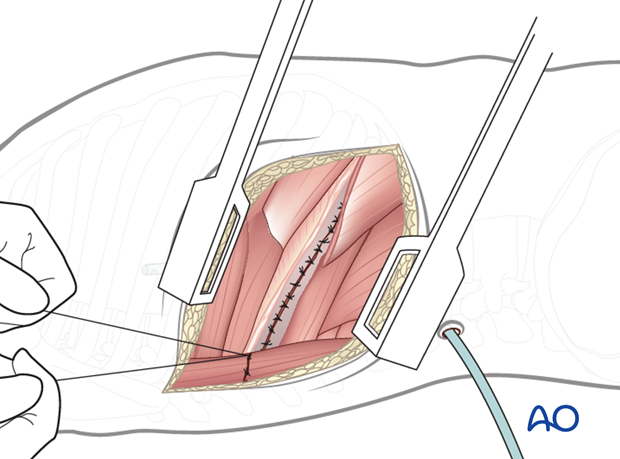 Thoracic and lumbar fractures: Right sided thoracotomy (T3-T10)