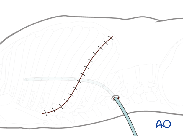 Thoracic and lumbar fractures: Right sided thoracotomy (T3-T10)