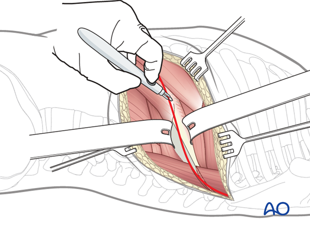 Thoracic and lumbar fractures: Left sided thoracotomy (T3-L1/2)