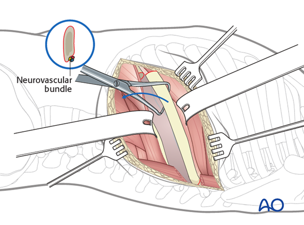 Thoracic and lumbar fractures: Left sided thoracotomy (T3-L1/2)