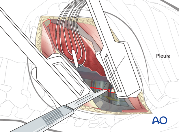 Thoracic and lumbar fractures: Left sided thoracotomy (T3-L1/2)