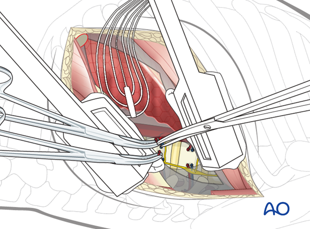 Thoracic and lumbar fractures: Left sided thoracotomy (T3-L1/2)