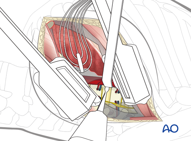 Thoracic and lumbar fractures: Left sided thoracotomy (T3-L1/2)