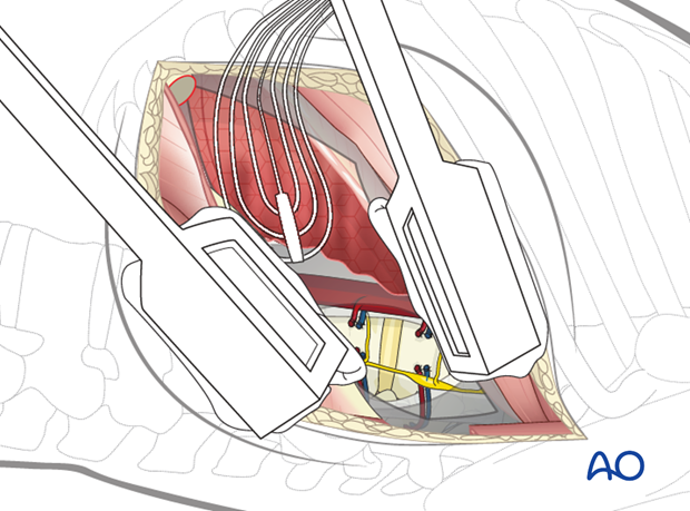 Thoracic and lumbar fractures: Left sided thoracolumbar junction approach (T10-L2) 