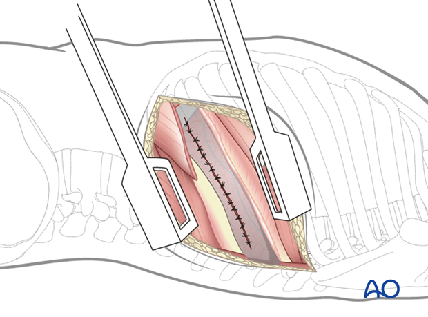 Thoracic and lumbar fractures: Left sided thoracotomy (T3-L1/2)