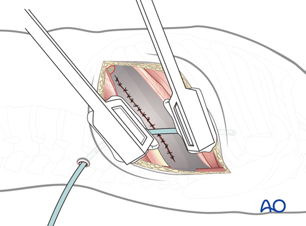 Thoracic and lumbar fractures: Left sided thoracotomy (T3-L1/2)