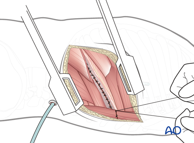 Thoracic and lumbar fractures: Left sided thoracotomy (T3-L1/2)