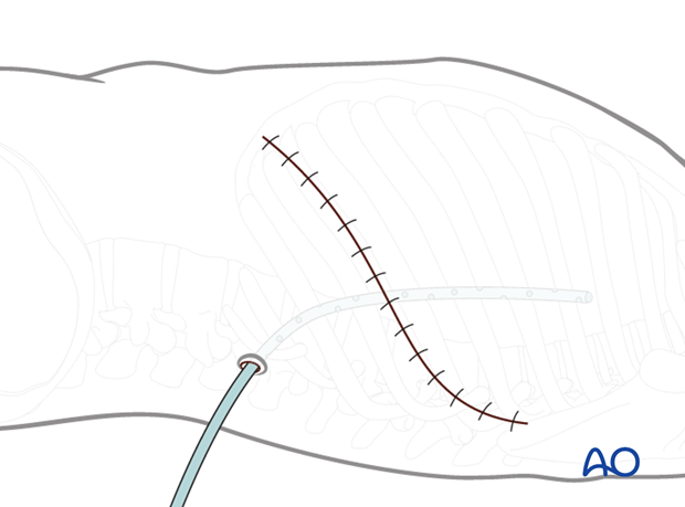 Thoracic and lumbar fractures: Left sided thoracotomy (T3-L1/2)