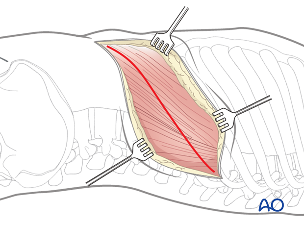 Thoracic and lumbar fractures: Left sided thoracolumbar junction approach (T10-L2) 