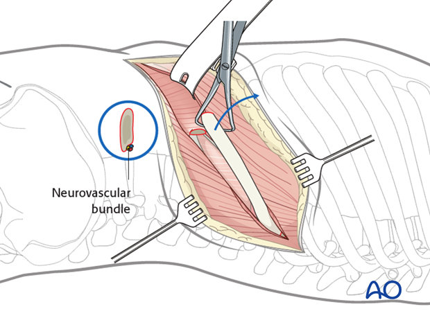 Thoracic and lumbar fractures: Left sided thoracolumbar junction approach (T10-L2) 