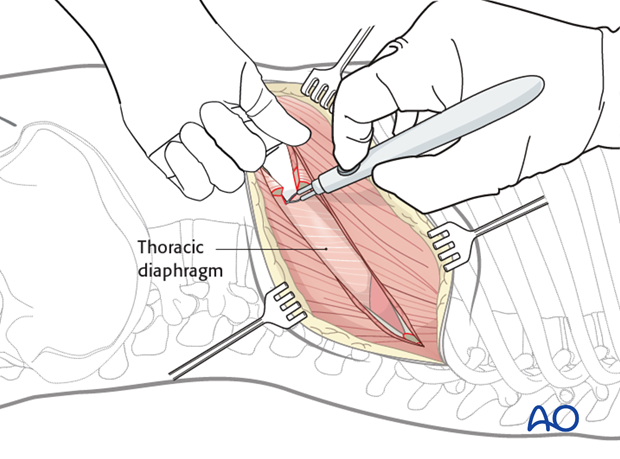 Thoracic and lumbar fractures: Left sided thoracolumbar junction approach (T10-L2) 