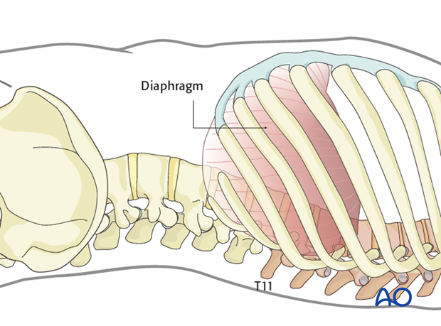 Thoracic and lumbar fractures: Left sided thoracolumbar junction approach (T10-L2) 