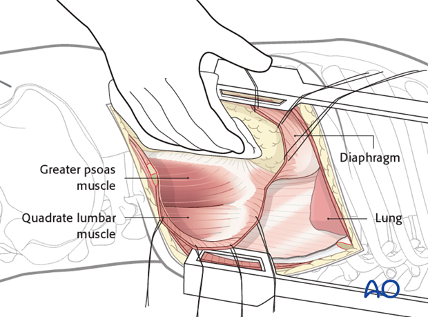 Thoracic and lumbar fractures: Left sided thoracolumbar junction approach (T10-L2) 