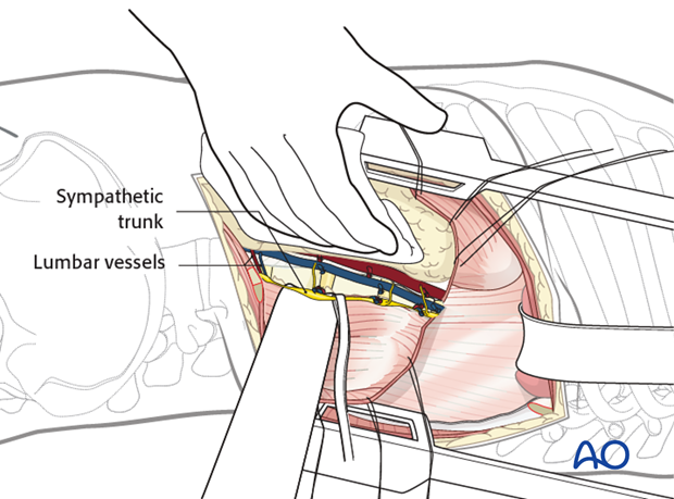 Thoracic and lumbar fractures: Left sided thoracolumbar junction approach (T10-L2) 