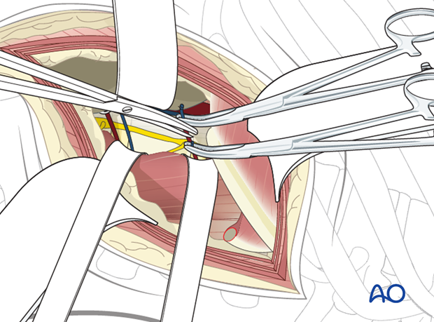 Thoracic and lumbar fractures: Left sided thoracolumbar junction approach (T10-L2) 