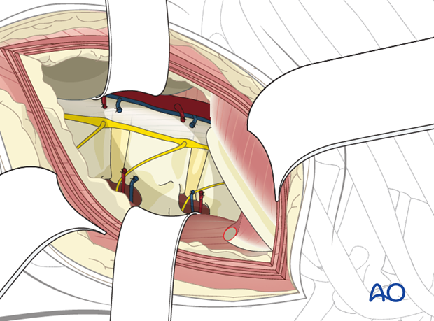 Thoracic and lumbar fractures: Left sided thoracolumbar junction approach (T10-L2) 