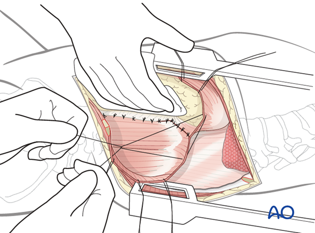 Thoracic and lumbar fractures: Left sided thoracolumbar junction approach (T10-L2) 