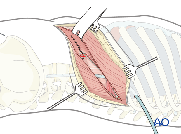 Thoracic and lumbar fractures: Left sided thoracolumbar junction approach (T10-L2) 