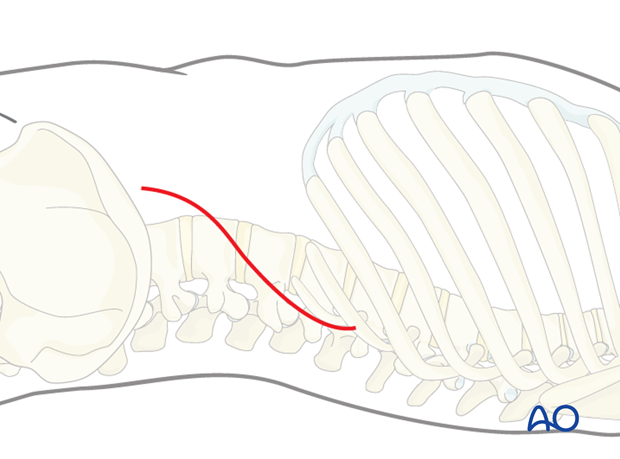 Lumbotomy (L1-L4)