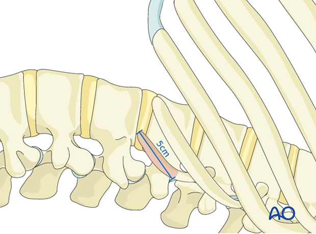 Thoracic and lumbar fractures: Lumbotomy (L1-L4)