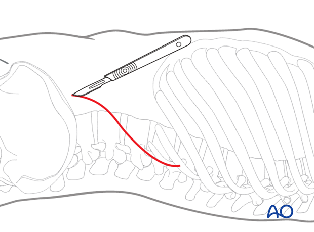 Thoracic and lumbar fractures: Lumbotomy (L1-L4)