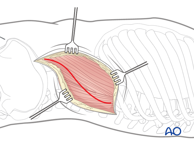 Thoracic and lumbar fractures: Lumbotomy (L1-L4)