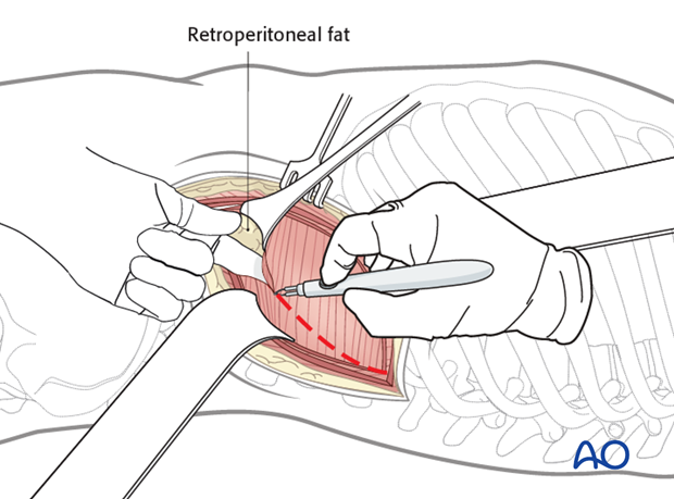 Thoracic and lumbar fractures: Lumbotomy (L1-L4)