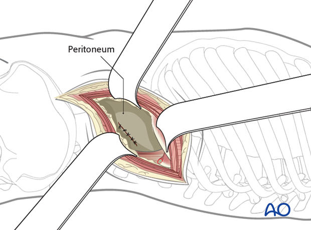 Thoracic and lumbar fractures: Lumbotomy (L1-L4)