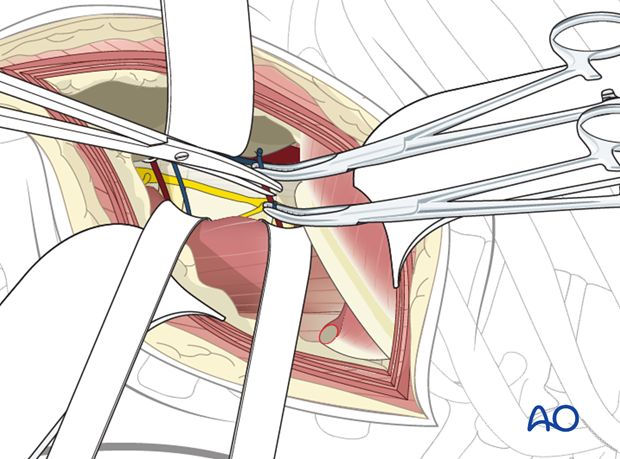 Thoracic and lumbar fractures: Lumbotomy (L1-L4)