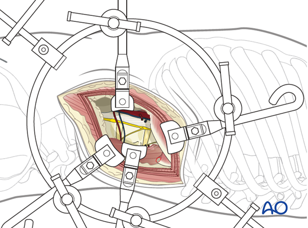 Thoracic and lumbar fractures: Lumbotomy (L1-L4)