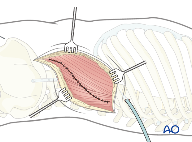 Thoracic and lumbar fractures: Lumbotomy (L1-L4)