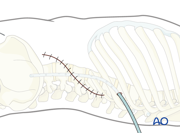 Thoracic and lumbar fractures: Lumbotomy (L1-L4)