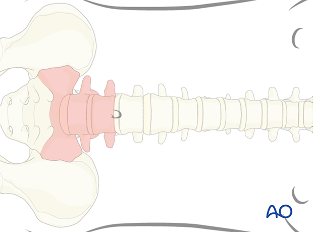 Thoracic and lumbar fractures: Mini open retroperitoneal approach (L4-S1)