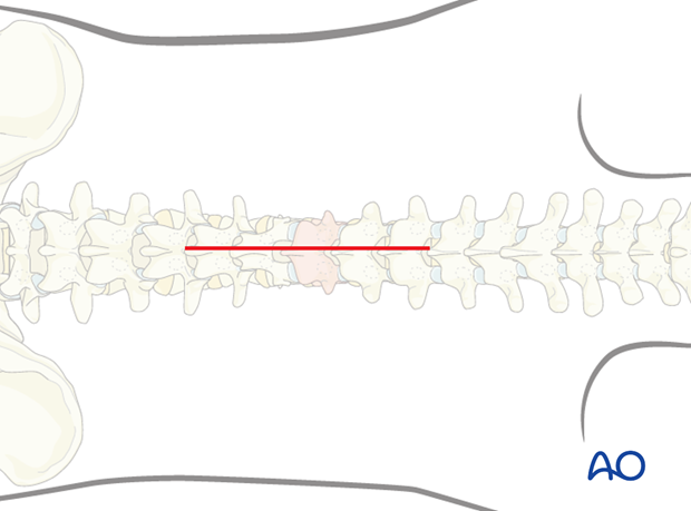 posterior open approach   midline approach t1 s1