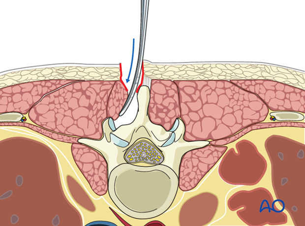 posterior open approach   midline approach t1 s1