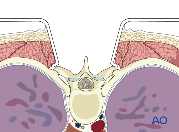 posterior open approach   midline approach t1 s1