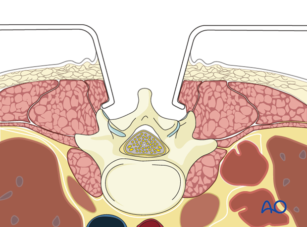 posterior open approach   midline approach t1 s1