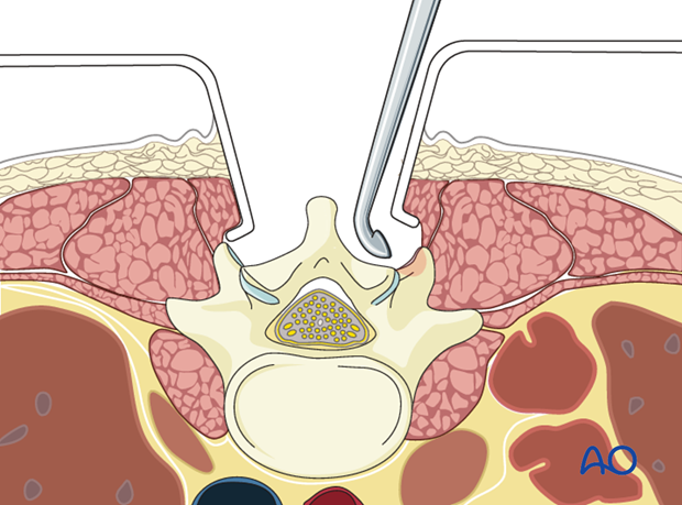 posterior open approach   midline approach t1 s1