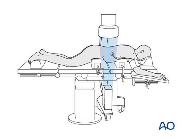 posterior open approach   midline approach t1 s1