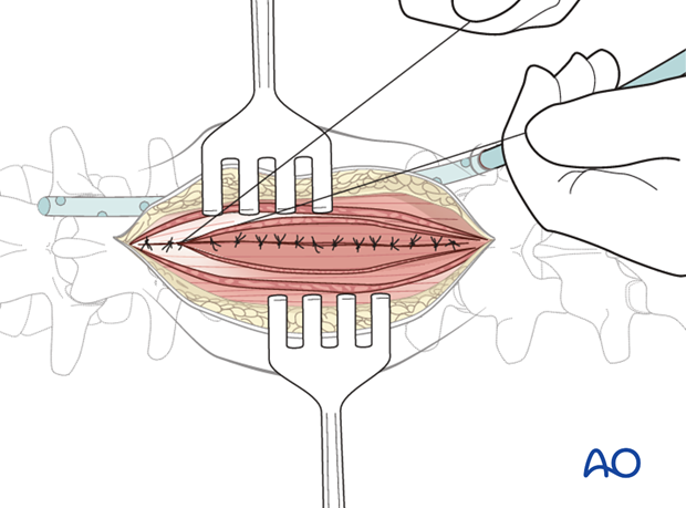 posterior open approach   midline approach t1 s1