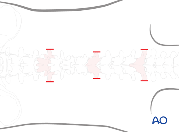 Percutaneous posterior approach for pedicle screw placement