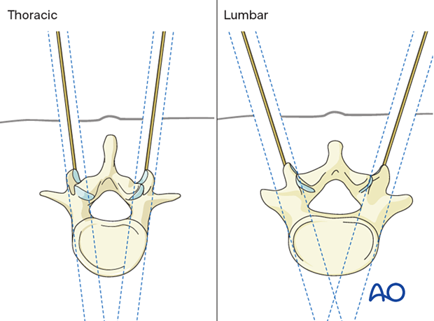 percutaneous posterior approach for pedicle screw placement