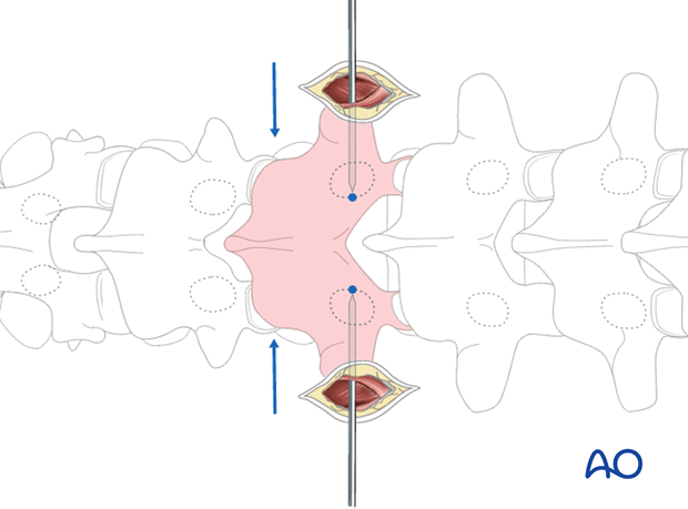 percutaneous posterior approach for pedicle screw placement