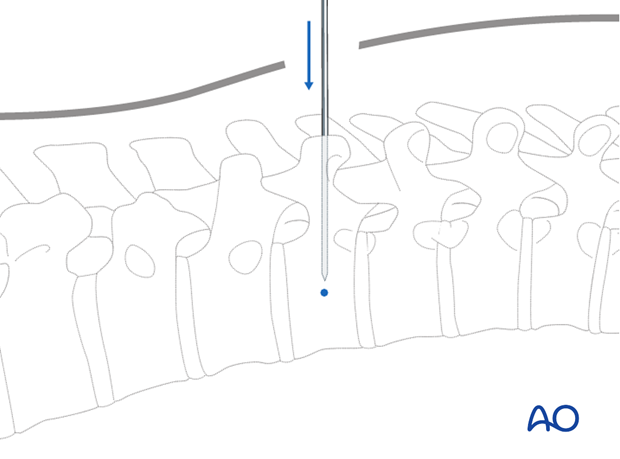 percutaneous posterior approach for pedicle screw placement