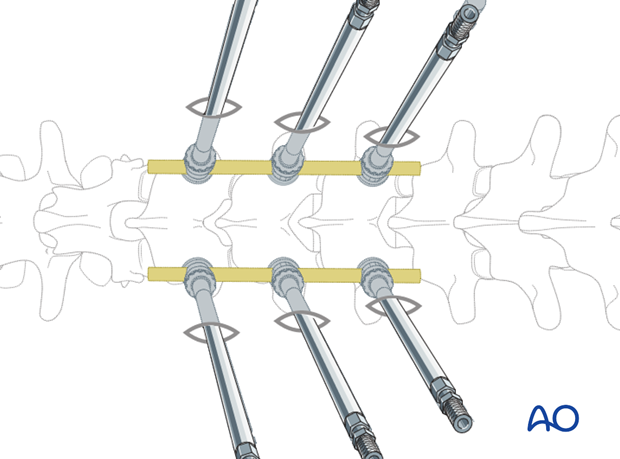 percutaneous posterior approach for pedicle screw placement