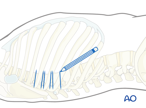 Thoracic and lumbar fractures: Minimally invasive right sided thoracic approach (T4-T10)