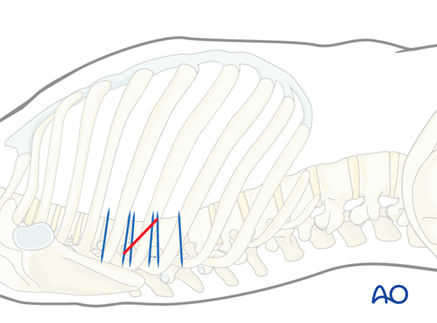 Thoracic and lumbar fractures: Minimally invasive right sided thoracic approach (T4-T10)