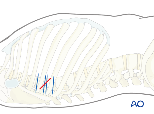 Thoracic and lumbar fractures: Minimally invasive right sided thoracic approach (T4-T10)