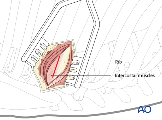 Thoracic and lumbar fractures: Minimally invasive right sided thoracic approach (T4-T10)